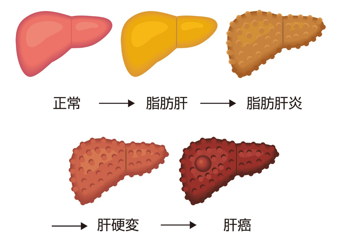 脂肪肝（脂肪肝炎）
